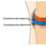 Симптомы и лечение остеоартроза суставов коленей: диагностика, степени